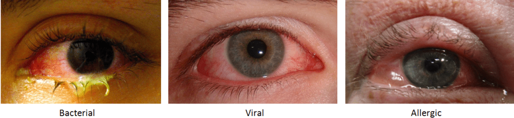 Viral Vs Bacterial Pink Eye