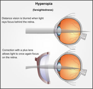 Hyperopia (Long Sightedness) | Beckenham Optometrist