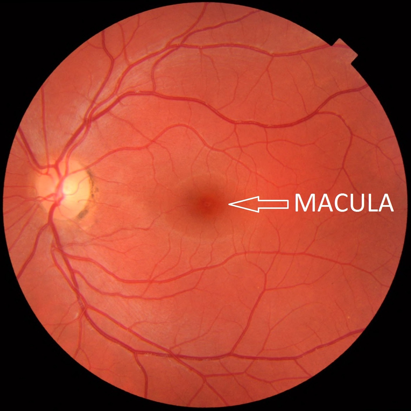 Macular Degeneration Beckenham Optometrist Avalon Nsw 